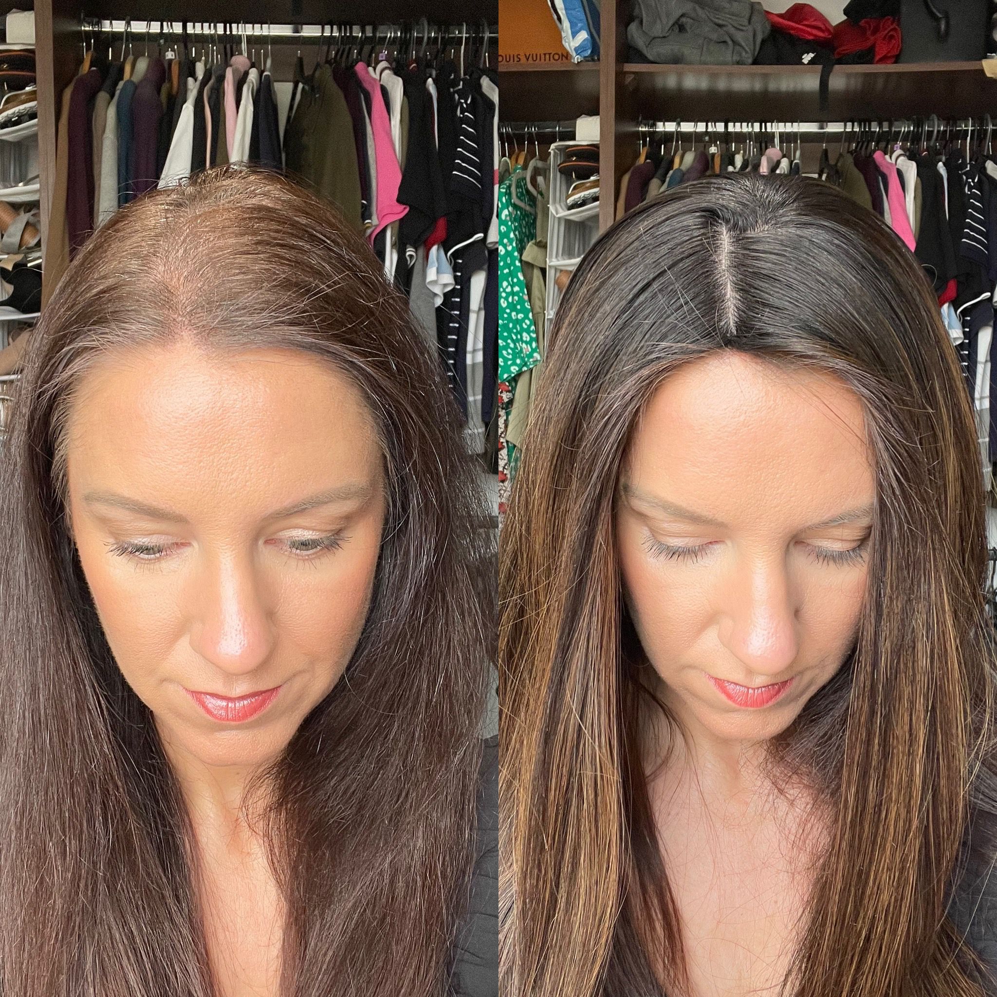 hair loss transformation