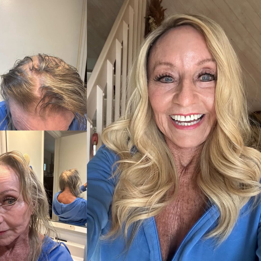 best hair topper uk before after hair loss